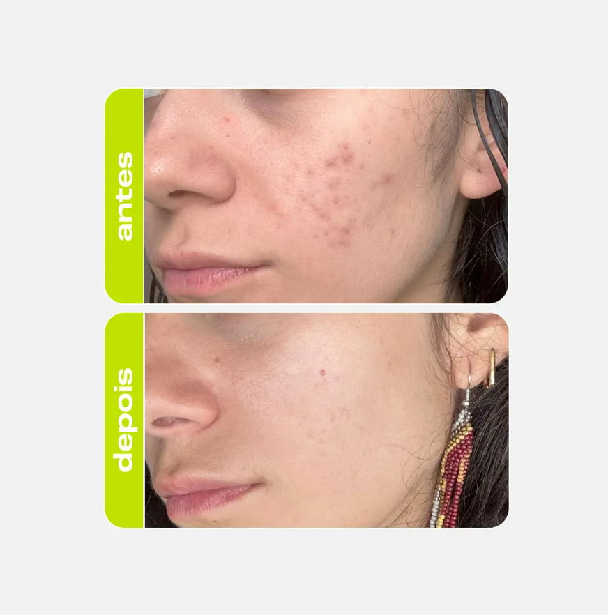 SOLUÇÃO CLAREADORA ÁCIDO TRANEXÂMICO - CREAMY