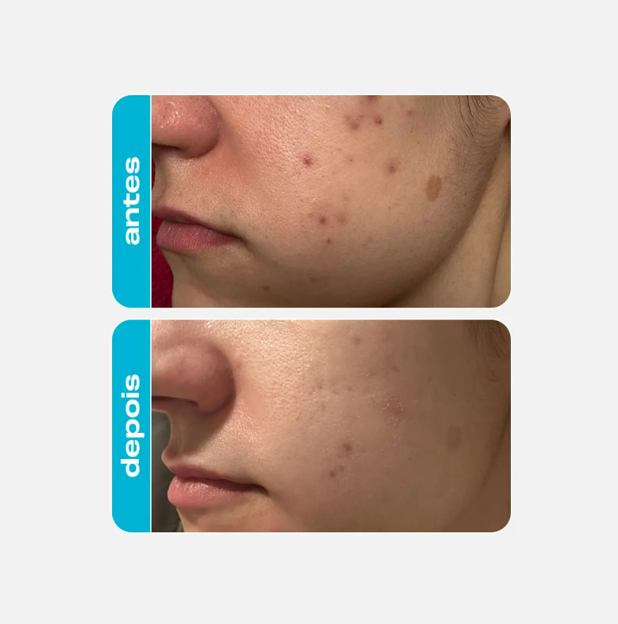 CREME 10% AHA ÁCIDO GLICÓLICO - CREAMY